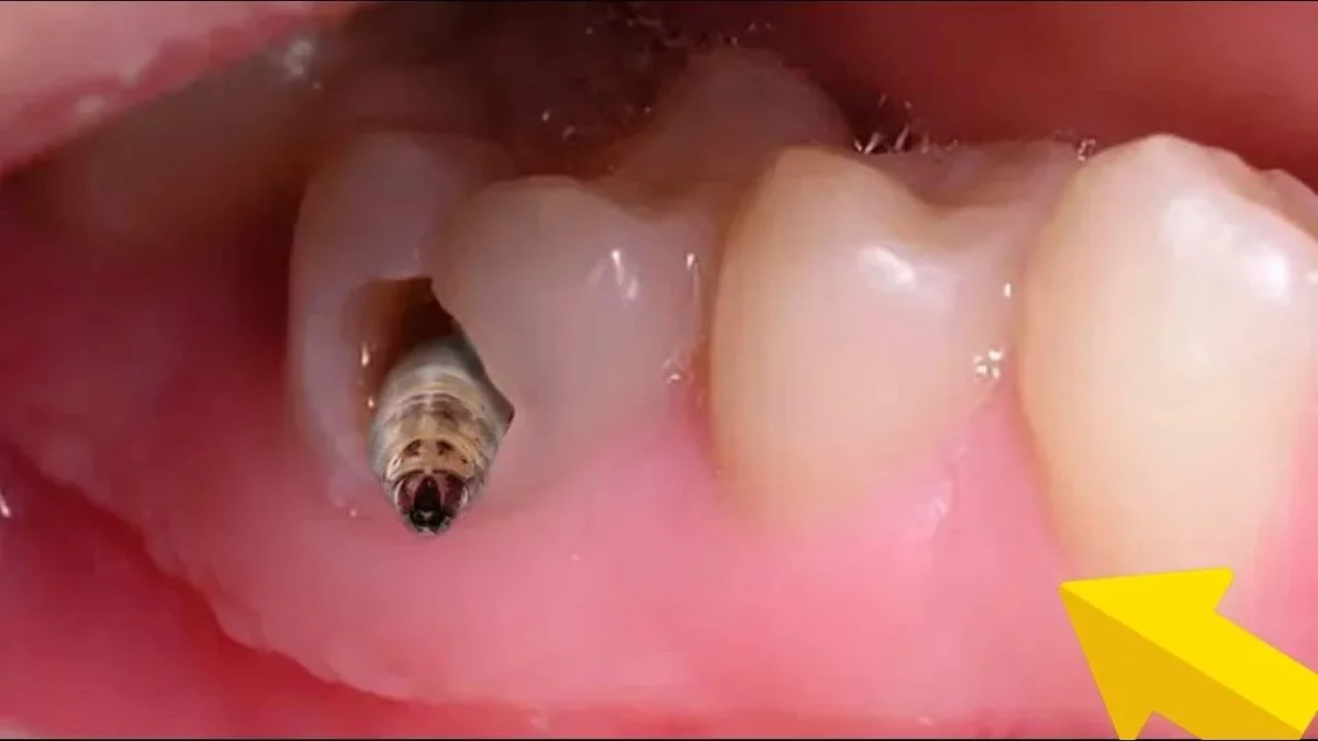 ฝันว่ามีหนอนเต็มปาก